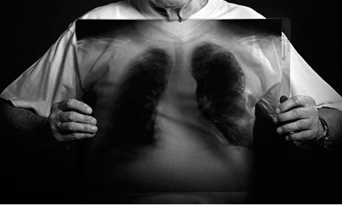www.mallorcadiario.com  fotos 1 uploads 2012 03 tuberculosisok