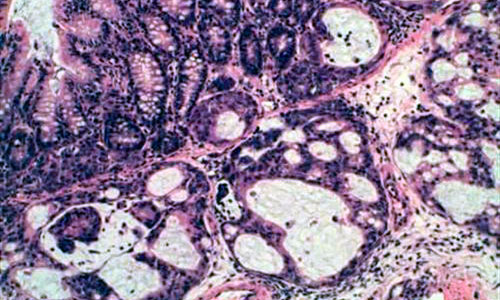www.mallorcadiario.com  fotos 1 uploads 2012 07 cancercolonrectook