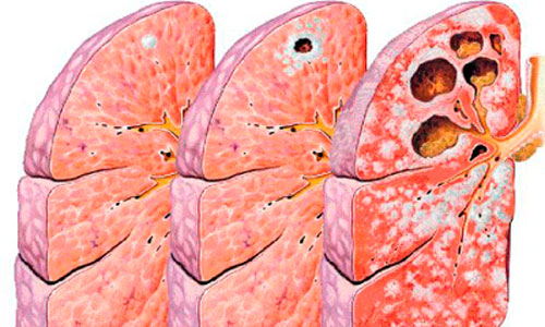 www.mallorcadiario.com  fotos 1 uploads 2012 08 tuberculosisok