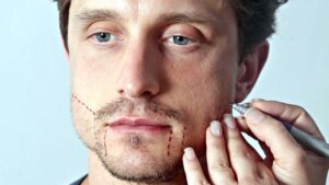 Implantes de barba