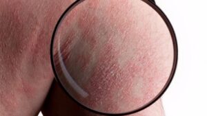 Psoriasis