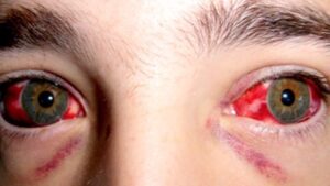 fiebre hemorr&aacute;gica