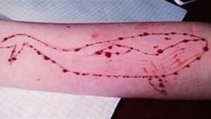 Automutilaci&oacute;n, una de las pruebas de la "ballena azul"