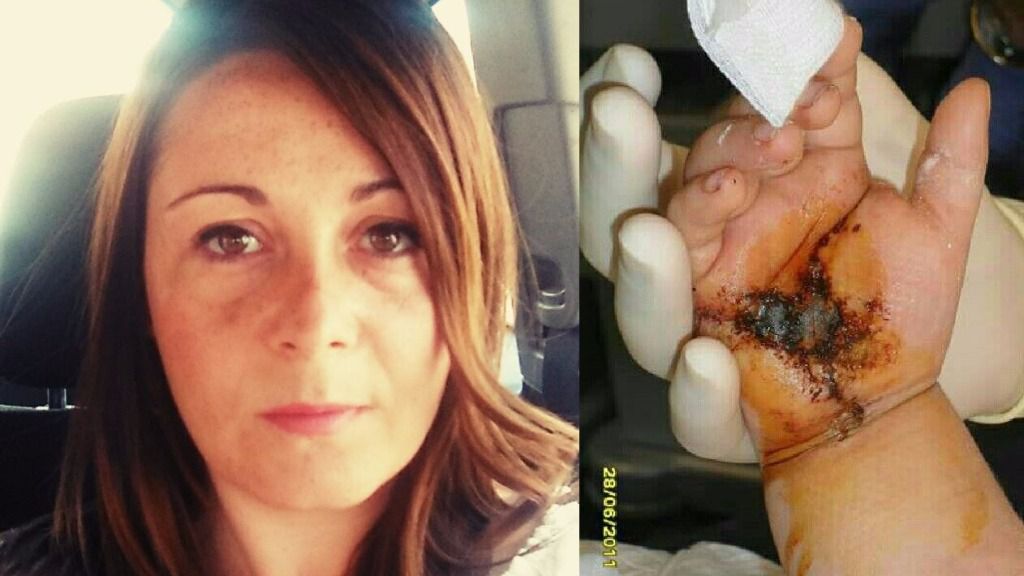 Marilén González (a la izquierda) , la madre que ha denunciado a Calvià por las heridas en la mano de su hija Nerea (derecha)