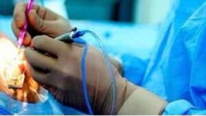 operaci&oacute;n cataratas