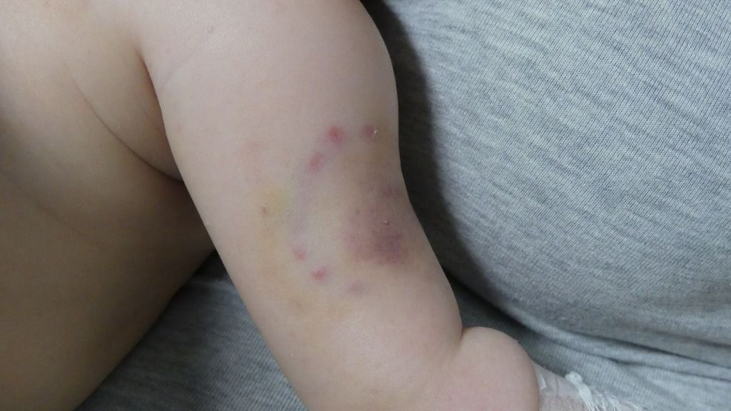 Imagen de la marca que presentaba en el brazo