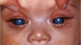 glaucoma congénito