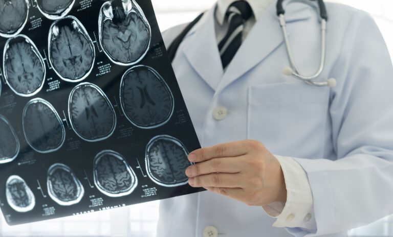 ictus cerebro