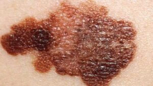 Melanoma