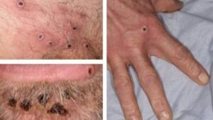 Manifestaciones cl&iacute;nicas de la viruela del mono