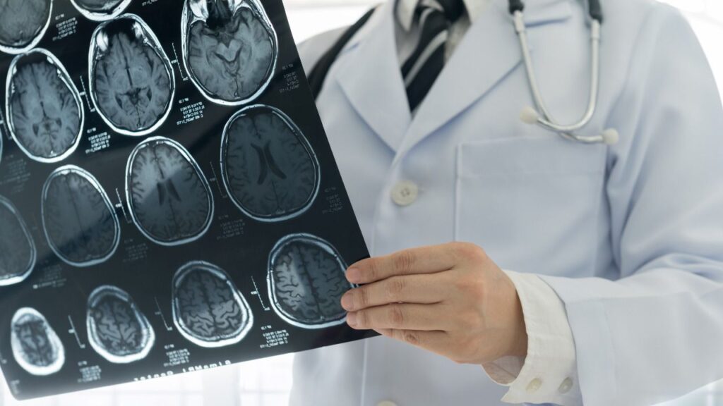 ictus cerebro