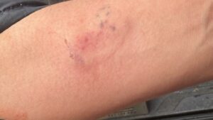 Mordisco en el antebrazo de la joven a su novio.