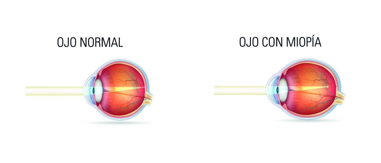 Miopía