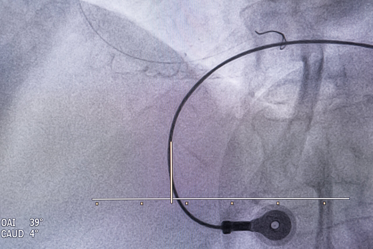 Imagen de un catéter en una sala de hemodinámica durante un procedimiento médico.