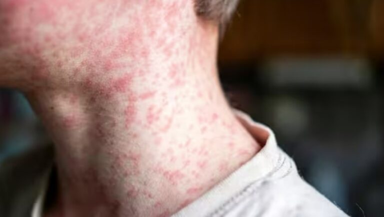 Niño con erupción cutánea visible en el cuello por sarampión