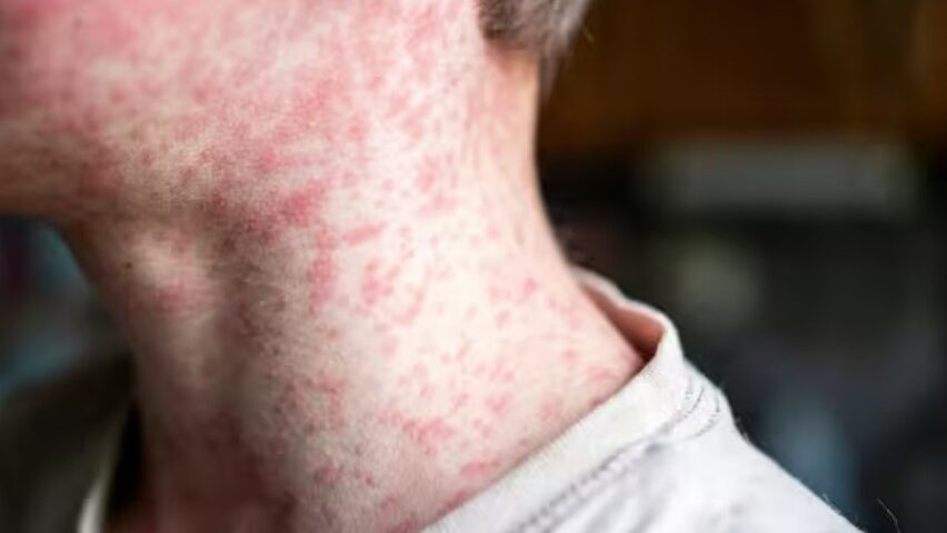 Niño con erupción cutánea visible en el cuello por sarampión
