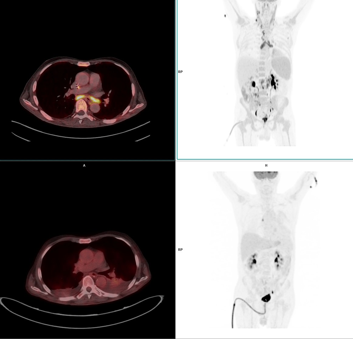 Imágenes de tomografía PET-CT mostrando secciones del tórax y abdomen.