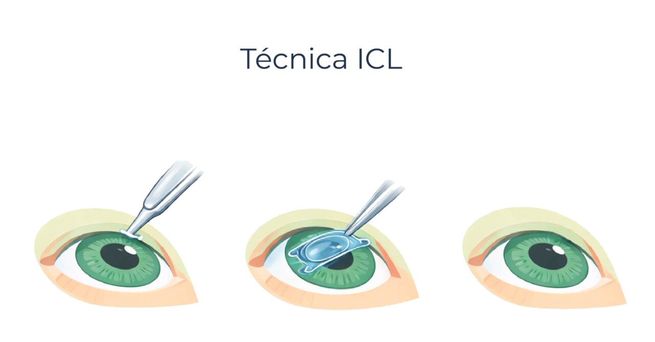 Proceso de la t&eacute;cnica ICL para corregir la visi&oacute;n