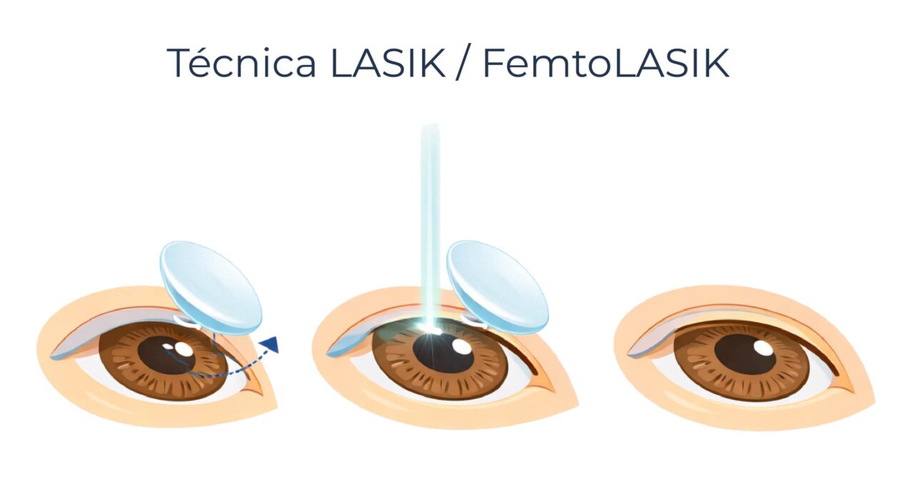Ilustraci&oacute;n de la t&eacute;cnica LASIK y FemtoLASIK en cirug&iacute;a ocular