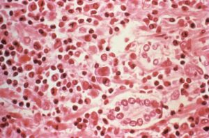 Muestra microsc&oacute;pica de c&eacute;lulas afectadas por hantavirus