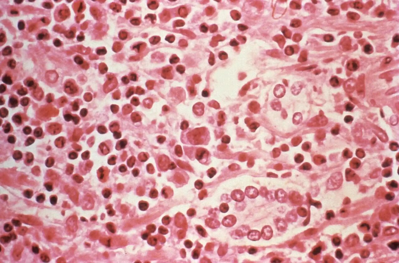Muestra microsc&oacute;pica de c&eacute;lulas afectadas por hantavirus