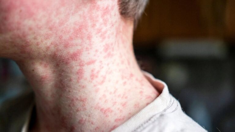 Salud detecta un brote de sarampi&oacute;n con al menos seis afectados en Mallorca